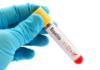 EN INVESTIGACIÓN TRES CASOS DE HEPATITIS DE ORIGEN DESCONOCIDO