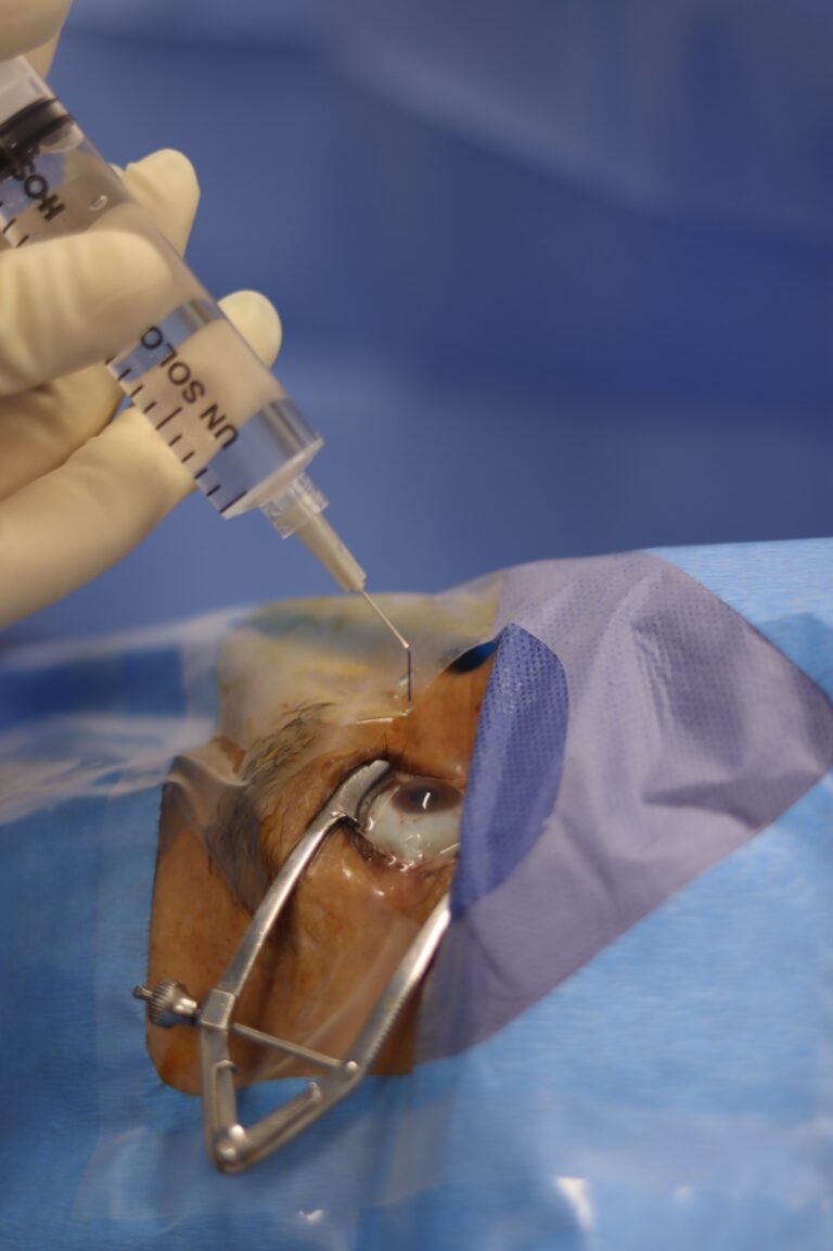 EN LA MEDICATURA FORENSE PODRÁN EXTRAER CORNEAS A CADÁVERES PARA DONACIÓN